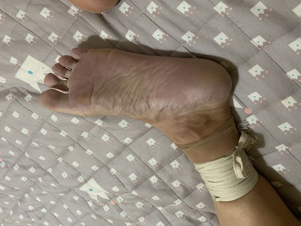 机械紧缚之脚丫坏死